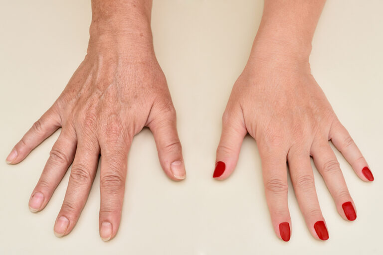 Hands Of A Woman Before And After Skin Treatment