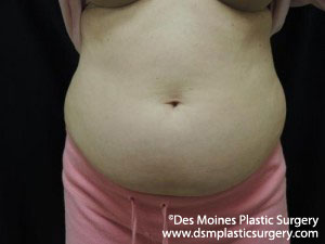 CoolSculpting Before and After Photo by Coachlight Clinic & Spa in West Des Moines Iowa