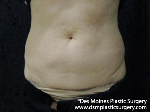 CoolSculpting Before and After Photo by Coachlight Clinic & Spa in West Des Moines Iowa