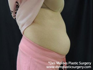 CoolSculpting Before and After Photo by Coachlight Clinic & Spa in West Des Moines Iowa