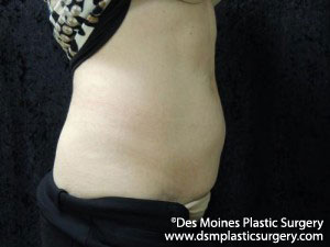 CoolSculpting Before and After Photo by Coachlight Clinic & Spa in West Des Moines Iowa