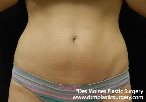 CoolSculpting Before and After Photo by Coachlight Clinic & Spa in West Des Moines Iowa