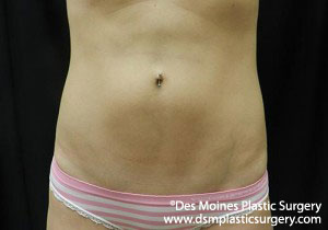 CoolSculpting Before and After Photo by Coachlight Clinic & Spa in West Des Moines Iowa