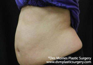 CoolSculpting Before and After Photo by Coachlight Clinic & Spa in West Des Moines Iowa