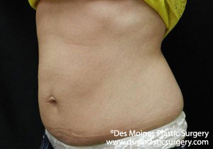 CoolSculpting Before and After Photo by Coachlight Clinic & Spa in West Des Moines Iowa