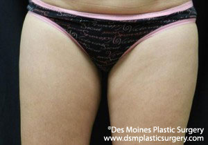 CoolSculpting Before and After Photo by Coachlight Clinic & Spa in West Des Moines Iowa