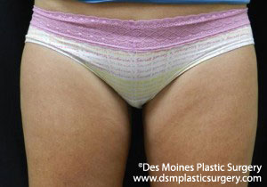 CoolSculpting Before and After Photo by Coachlight Clinic & Spa in West Des Moines Iowa