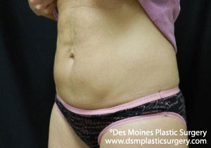 CoolSculpting Before and After Photo by Coachlight Clinic & Spa in West Des Moines Iowa