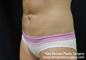 CoolSculpting Before and After Photo by Coachlight Clinic & Spa in West Des Moines Iowa