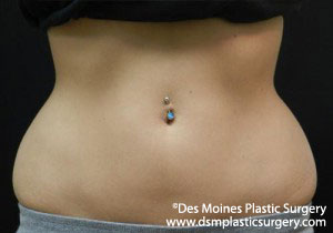 CoolSculpting Before and After Photo by Coachlight Clinic & Spa in West Des Moines Iowa