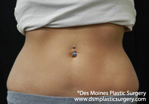 CoolSculpting Before and After Photo by Coachlight Clinic & Spa in West Des Moines Iowa