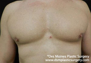 CoolSculpting Before and After Photo by Coachlight Clinic & Spa in West Des Moines Iowa
