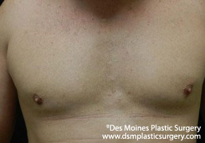 CoolSculpting Before and After Photo by Coachlight Clinic & Spa in West Des Moines Iowa