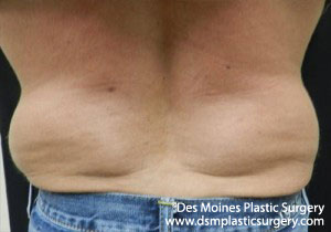 CoolSculpting Before and After Photo by Coachlight Clinic & Spa in West Des Moines Iowa