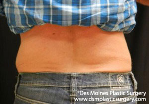 CoolSculpting Before and After Photo by Coachlight Clinic & Spa in West Des Moines Iowa