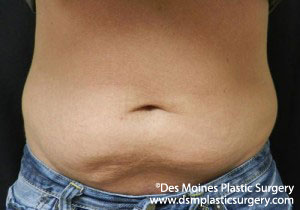 CoolSculpting Before and After Photo by Coachlight Clinic & Spa in West Des Moines Iowa