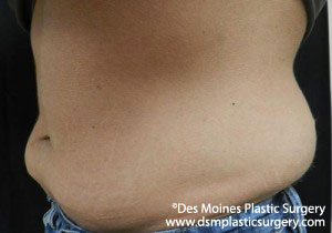 CoolSculpting Before and After Photo by Coachlight Clinic & Spa in West Des Moines Iowa