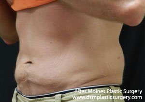 CoolSculpting Before and After Photo by Coachlight Clinic & Spa in West Des Moines Iowa