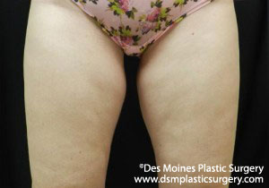CoolSculpting Before and After Photo by Coachlight Clinic & Spa in West Des Moines Iowa