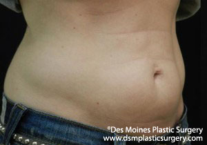 CoolSculpting Before and After Photo by Coachlight Clinic & Spa in West Des Moines Iowa