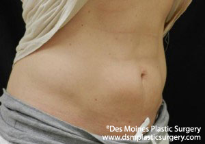 CoolSculpting Before and After Photo by Coachlight Clinic & Spa in West Des Moines Iowa