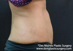 CoolSculpting Before and After Photo by Coachlight Clinic & Spa in West Des Moines Iowa