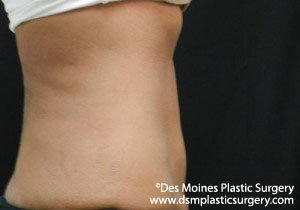 CoolSculpting Before and After Photo by Coachlight Clinic & Spa in West Des Moines Iowa