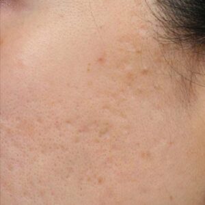INTRAcel™ Microneedling Before and After Photo by Coachlight Clinic & Spa in West Des Moines Iowa