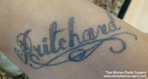 Tattoo Removal Before and After Photo by Coachlight Clinic & Spa in West Des Moines Iowa