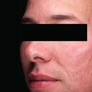 INTRAcel™ Microneedling Before and After Photo by Coachlight Clinic & Spa in West Des Moines Iowa
