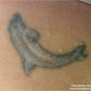Tattoo Removal Before and After Photo by Coachlight Clinic & Spa in West Des Moines Iowa