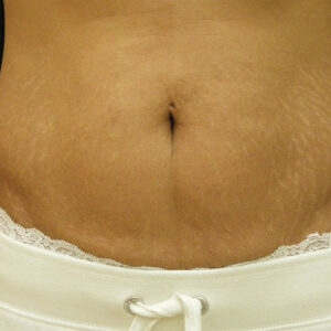SkinTyte Before and After Photo by Coachlight Clinic & Spa in West Des Moines Iowa