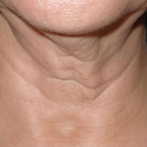 SkinTyte Before and After Photo by Coachlight Clinic & Spa in West Des Moines Iowa