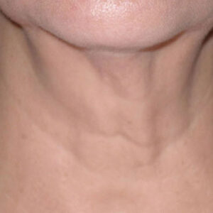 SkinTyte Before and After Photo by Coachlight Clinic & Spa in West Des Moines Iowa