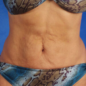 SkinTyte Before and After Photo by Coachlight Clinic & Spa in West Des Moines Iowa