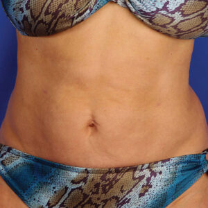 SkinTyte Before and After Photo by Coachlight Clinic & Spa in West Des Moines Iowa