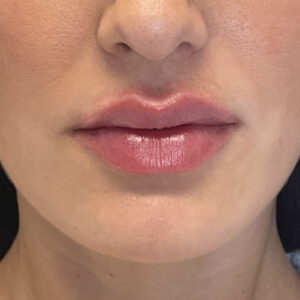 Lip Filler Before and After Photo by Coachlight Clinic & Spa in West Des Moines Iowa