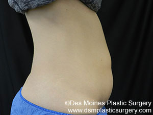 CoolSculpting Before and After Photo by Coachlight Clinic & Spa in West Des Moines Iowa