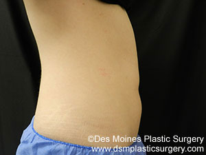 CoolSculpting Before and After Photo by Coachlight Clinic & Spa in West Des Moines Iowa