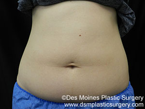 CoolSculpting Before and After Photo by Coachlight Clinic & Spa in West Des Moines Iowa