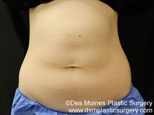 CoolSculpting Before and After Photo by Coachlight Clinic & Spa in West Des Moines Iowa