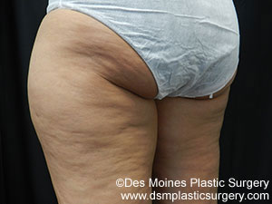 CoolSculpting Before and After Photo by Coachlight Clinic & Spa in West Des Moines Iowa