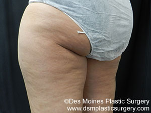 CoolSculpting Before and After Photo by Coachlight Clinic & Spa in West Des Moines Iowa