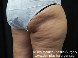 CoolSculpting Before and After Photo by Coachlight Clinic & Spa in West Des Moines Iowa