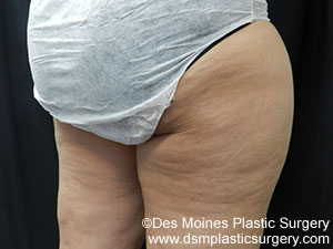CoolSculpting Before and After Photo by Coachlight Clinic & Spa in West Des Moines Iowa