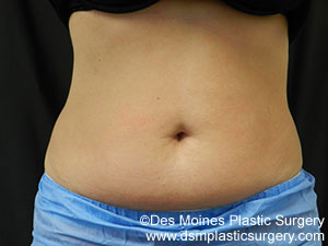 CoolSculpting Before and After Photo by Coachlight Clinic & Spa in West Des Moines Iowa