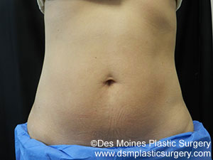 CoolSculpting Before and After Photo by Coachlight Clinic & Spa in West Des Moines Iowa