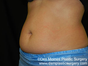 CoolSculpting Before and After Photo by Coachlight Clinic & Spa in West Des Moines Iowa