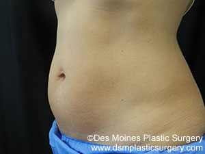 CoolSculpting Before and After Photo by Coachlight Clinic & Spa in West Des Moines Iowa