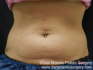 CoolSculpting Before and After Photo by Coachlight Clinic & Spa in West Des Moines Iowa
